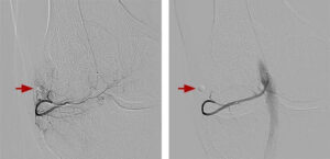 Comparison of two images after embolization in two knees